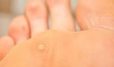 Corns and Calluses Friendly Feet Podiatry